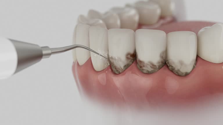 Reliable Tooth Extraction contractor in Somerville, MA by Smile Center Dentistry